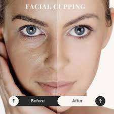 Facial cupping set